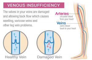 Your Vein Health - Vein Conditions | Triangle Vein Clinic - Cary, NC