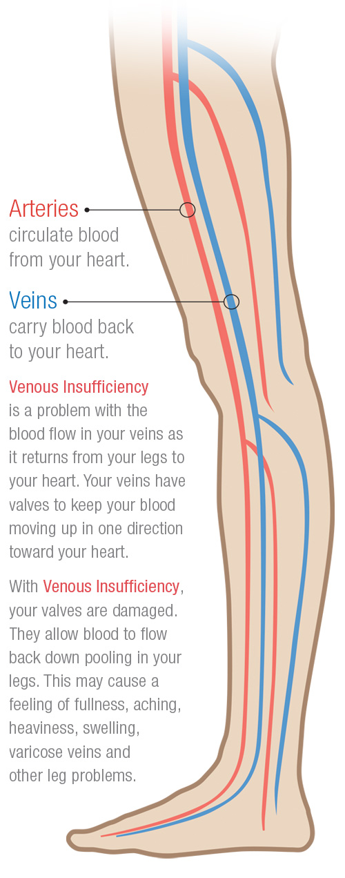 Venous Insufficiency - Vein Conditions | Triangle Vein Clinic - Cary, NC