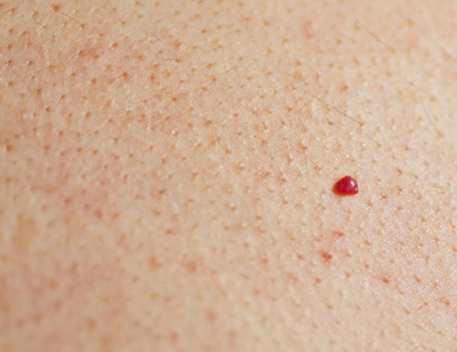 red purple pinpoint spots skin